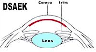 Als enkel het achterste deel van het hoornvlies vervangen wordt, spreekt met van een posterieure lamellaire keratoplastie (DSAEK of DMEK).