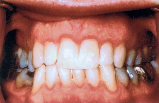 Daarbij was er een geringe toename van symptomen van parodontale ontsteking en afbraak met de leeftijd.