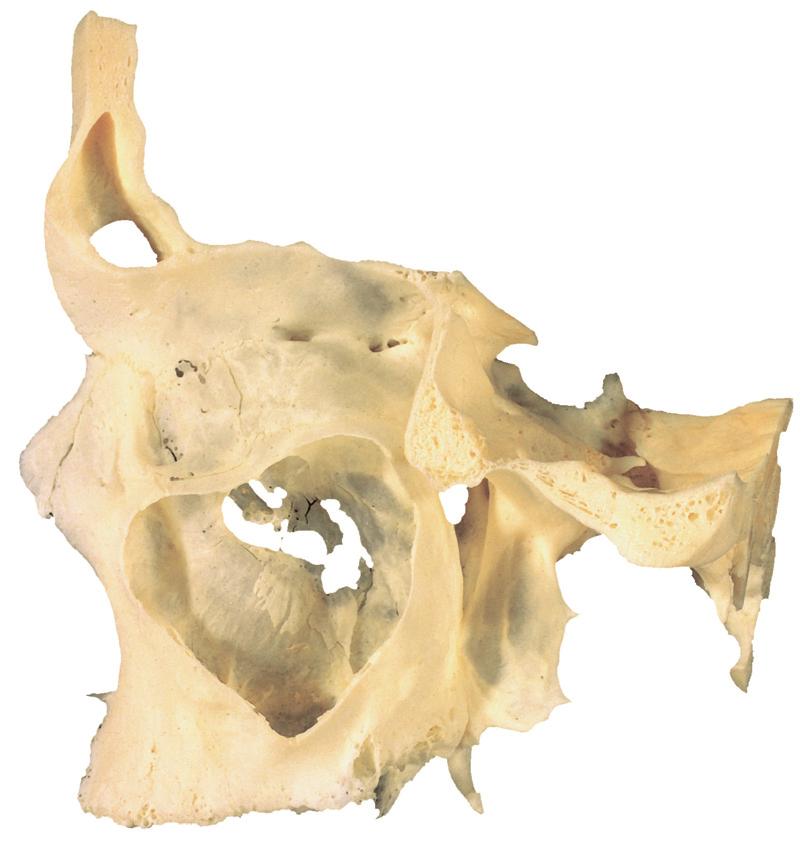 Neusbijholten 4 2.94 Sinus maxillaris met een deel van de schedel, links-lateraal. [1] Sinus frontalis Foramen ethmoidale anterius Foramina ethmoidalia posteriora (var.