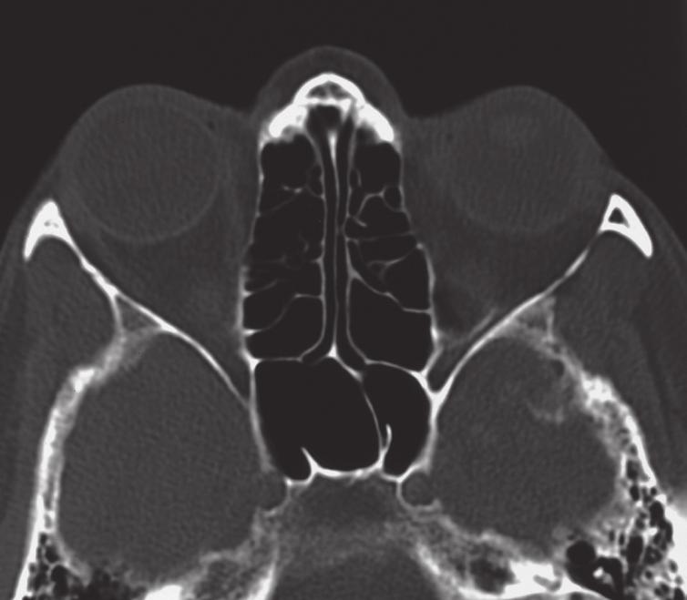 ) Canalis infraorbitalis Processus uncinatus Sinus maxillaris Concha nasi inferior Vagina bulbi Lamina perpendicularis van het os ethmoidale Bulla ethmoidalis Meatus nasi