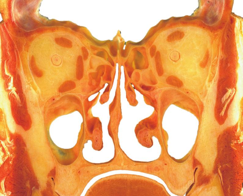 Neusholte en neusbijholtes 1 2.86 Frontale snede door het hoofd bij de crista galli, aanzicht van het achterste snijvlak. [6] tumdeviatie kan de emhaling bemoein gepaard gaan met mie of anosmie en jn.