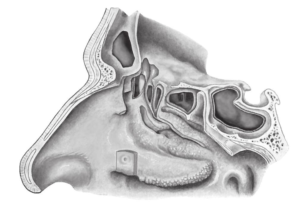 Bij volwassenen betreft het meestal de kaakholte, bij kinderen de zeefbeencellen.