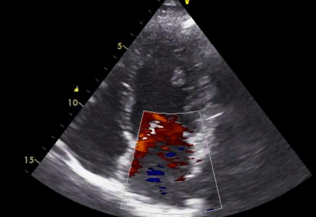 Casussen Man, 26/09/1972 Echocardiografie 1. Normotroof, gedilateerd LV met globale ernstig hypokinesie (EF 32% via biplane simpson) 2. Geen LA dilatatie 3.