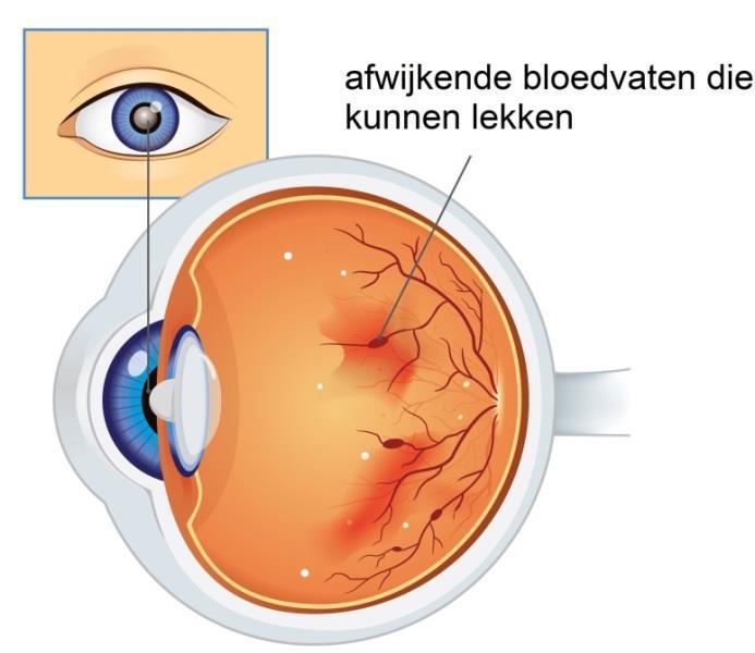 Afdeelding 3: Situatie bij diabetische retinopathie U kunt al langere tijd suikerziekte hebben, zonder dat u dat weet.