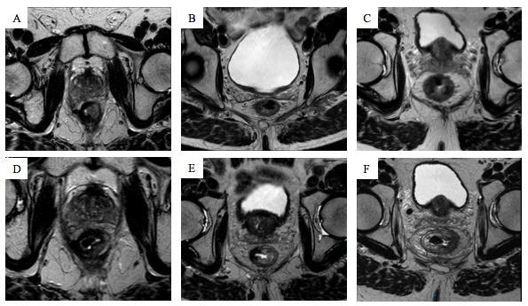 RESULTATEN Irregulaire fibrose op T2W-MRI