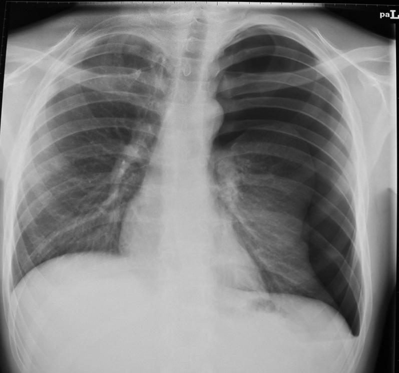 THORACOSCOPIE / -TOMIE: INDICATIES Pleura Benigne aandoeningen Pneumothorax Pleuravocht (pleurectomie,