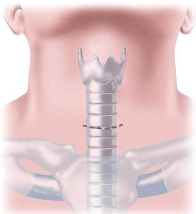 MEDIASTINOSCOPIE: TECHNIEK 3cm