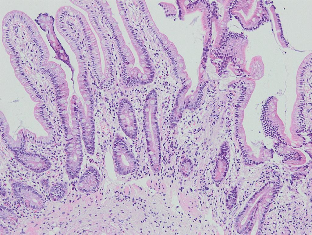 ditmaal vergrote mesenteriale lymfeklieren. Histologisch onderzoek van een laparoscopisch verwijderde lymfeklier liet echter alleen reactieve veranderingen zien.