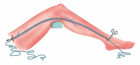 Doorheen deze ader wordt een katheter (hol buisje) of zelfs een stevige draad getrokken. Deze wordt bovenaan vastgeknoopt aan de ader en vervolgens wordt die ader er onderaan uitgetrokken.
