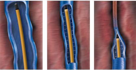 VERHITTING VAN DE ADER LASERABLATIE Bij het gebruik van laser wordt een katheter (een hol buisje, figuur 12) met daarin een glasvezel (fiber) in de ader gebracht.