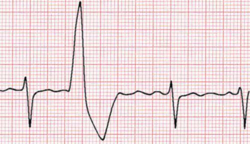 Hartritmestoornissen 2 2 Visolie trials Geen effect op ECG, hartritmevariabiliteit en baroreflexgevoeligheid bij gezonden Geen effect op