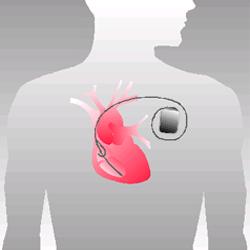 Visolietrials 2: de Europese SOFA trial Patiënten met ICD-imlantatie wegens ritmestoornis ICD: Implantable Cardioverter