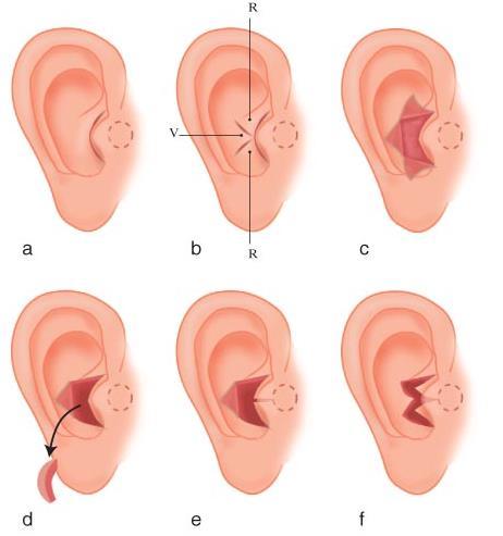 De meatus Midden in de oorschelp zit de opening van de, gehoorgang. Deze opening wordt de meatus genoemd. Het deel van de gehoorgang dat zich het dichtst bij de oorschelp bevindt, is van kraakbeen.