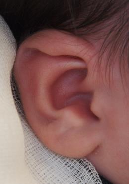 Welke oor afwijkingen kunnen gecorrigeerd worden met afplakken? Niet alle oorafwijkingen kunnen met afplakken behandeld worden.