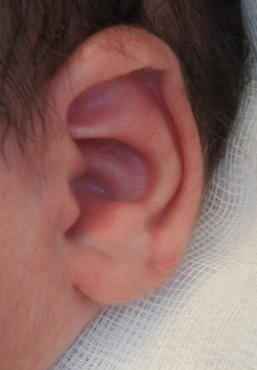 Dit wordt ook wel Spock-oor genoemd - Lop oor o Hierbij is sprake van een overhang van de bovenrand van het oor (de rand is omgeklapt).