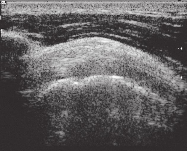 Schouder: beeldvorming 2 6.18 Echografie van de schouder. [73] M.