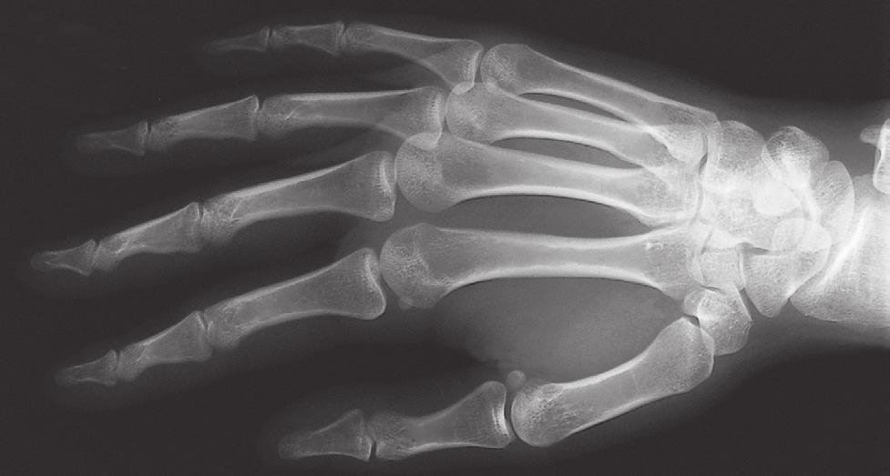 Vingergewrichten 3 6.31 Röntgenfoto van de rechter hand van een 22-jarige vrouw, schuin dorsaal-palmaire opname.