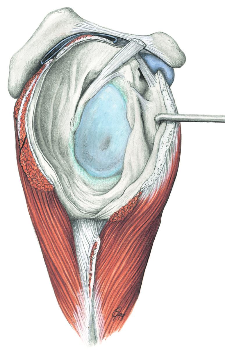 biceps brachii Processus coracoideus coracoglenoidale Bursa subtendinea musculi subscapularis glenohumerale superius Foramen van Weitbrecht glenohumerale medium Capsula articularis Cavitas