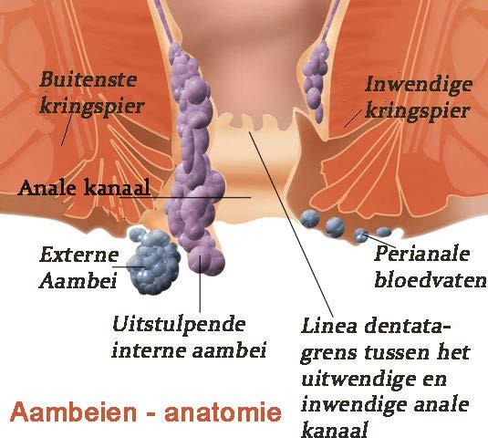 Aambeien (Hemorroïden) Slijmvlieszwelling van rectum Vaker bij ouderen dan bij