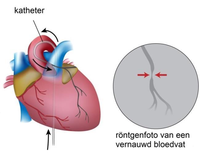 Afbeelding 3B: De katheter ligt in het hart. Het opschuiven en bewegen van de katheters voelt u niet omdat er aan de binnenkant van uw bloedvaten geen gevoelszenuwen zitten.