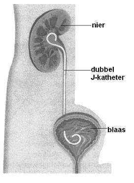 Figuur 2.dubbel-J-katheter Het verwijderen van de niersteen De uroloog plaatst door de huid van de rug een naald in de nier.