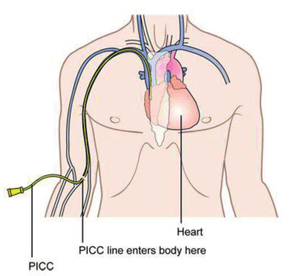 WAT IS EEN PICC? Voor de behandeling van uw ziekte krijgt u op dit moment regelmatig medicijnen en/of bloedproducten via een infuus.