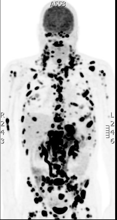 Interessante casus M, 62j; GE junctie adenocarcinoma NGS; aanwijzing voor MET genamplificatie