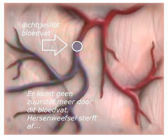 Een beroerte (CVA) kan ontstaan door: het dichtslibben van een ader (zie tekening hiernaast) een bloedstolsel dat het bloedvat afsluit (een herseninfarct) doordat een bloedvat