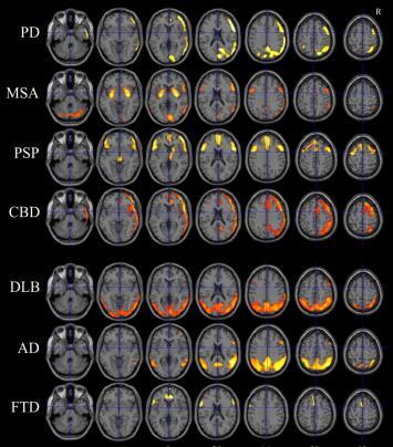 Posterior cingulate, precuneus (pariëtotemporaal) = think AD! Frontotemporaal = think FTD!