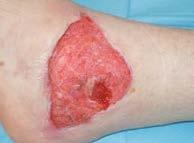 : diabetische voetinfecties met ulceratie 7 De werd gestart met V.A.C.