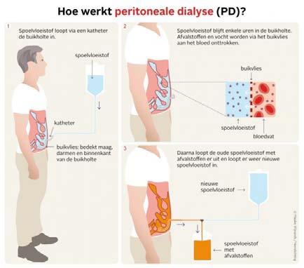 Schematische weergave van peritoneaal dialyse. Bron afbeelding www.nieren.nl Voor de behandeling wordt het eigen buikvlies (peritoneum) als filter gebruikt.