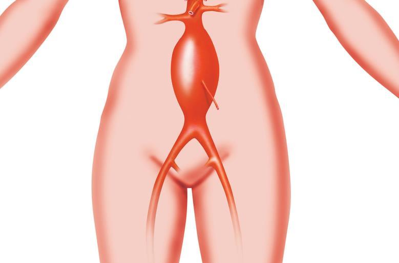 Fig. 2 : Een aneurysma (uitzetting) op de aorta (grote lichaamsslagader) in de buik. Wat zijn de oorzaken?