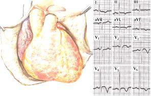 Pericarditis en pericard effusie