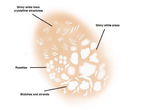 Dermatoscopische structuren suspect voor melanoom Cristalline structuren (witte lijnen) Enkel zichtbaar met