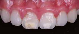 Ook het tandvlees is veel rustiger: veel minder zwelling en roodheid (afbeelding 29).