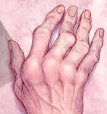 Het is een seronegatieve vorm van artritis, wat wil zeggen dat een bloedonderzoek geen echte ja/nee factor zal kunnen aantonen.