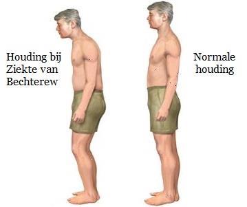 Blijft het beperkt tot het bekken? Het optreden van ontsteking blijft niet beperkt tot het bekken.