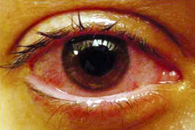 aangetast. Belangrijk om te vermelden is de uveïtis, de typische oogontsteking bij spondyloartritis.