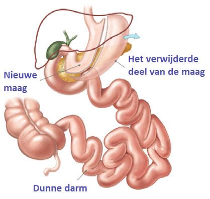 De Gastric Sleeve Bij de Gastric Sleeve wordt de maag ook verkleind, maar niet zo klein als bij de Gastric Bypass. De maag wordt een soort van koker in plaats van de normale vorm van een opvangzak.