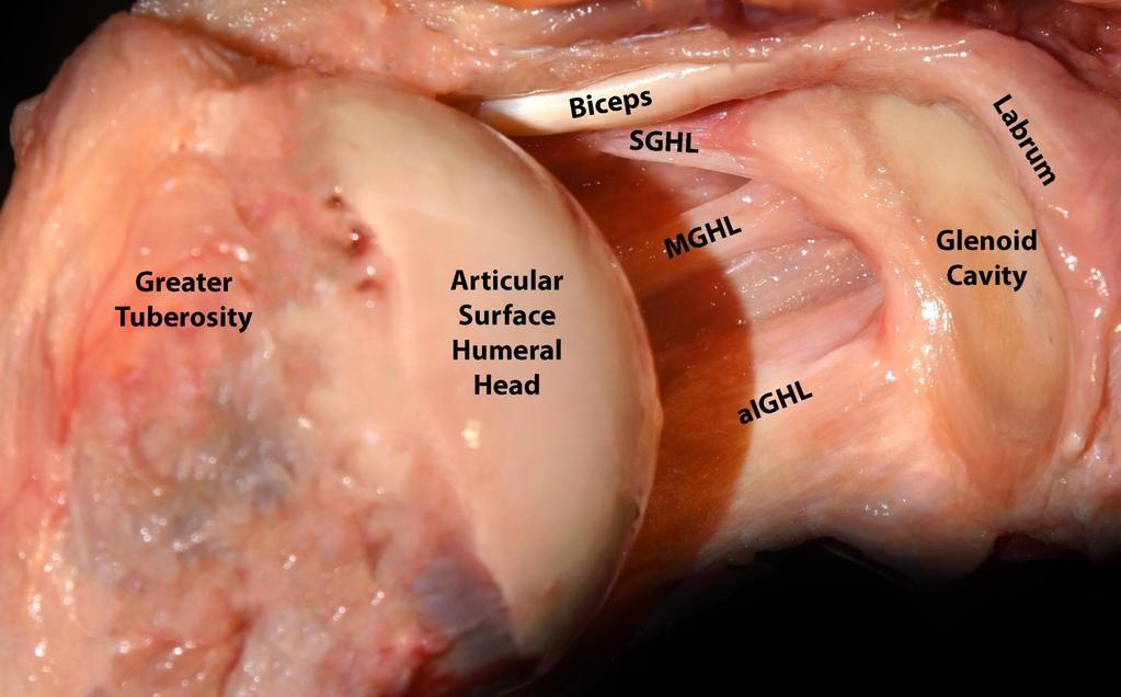 Het SGHL (Superieure GH Ligament) geeft verloop RCI aan;