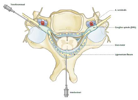 Deze folder is bestemd voor patiënten, die in aanmerking komen voor een injectie met ontstekingsremmende medicijnen rond een zenuwwortel in de rug (lumbaal) of nek (cervicaal) in dagbehandeling.