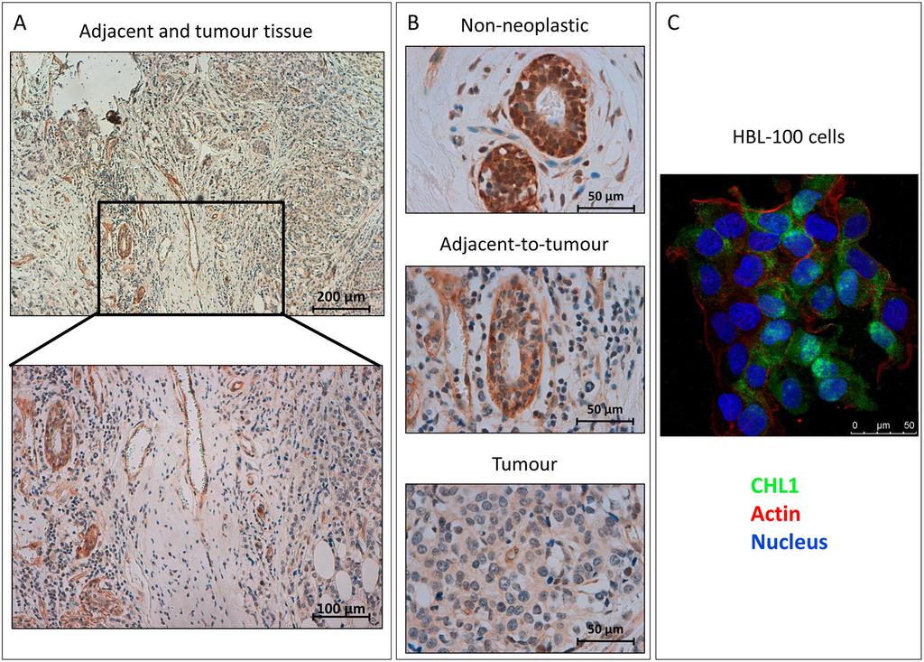 Supplementary Figure 3: CHL1 protein expression pattern in BC. Representative pictures of mammary tissues immunostained with CHL1 antibody. A.