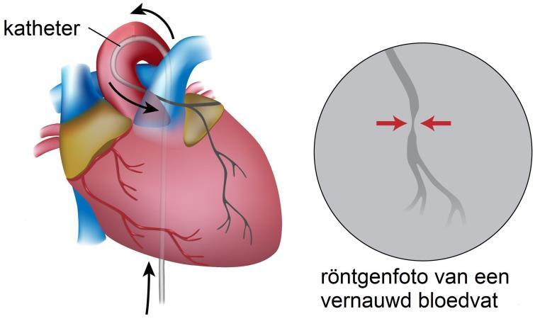 Afbeelding 3B: De katheter ligt in het hart. Contrastvloeistof De cardioloog spuit ook een beetje contrastvloeistof in de katheter. Dit kan even een warm gevoel in uw lichaam geven.