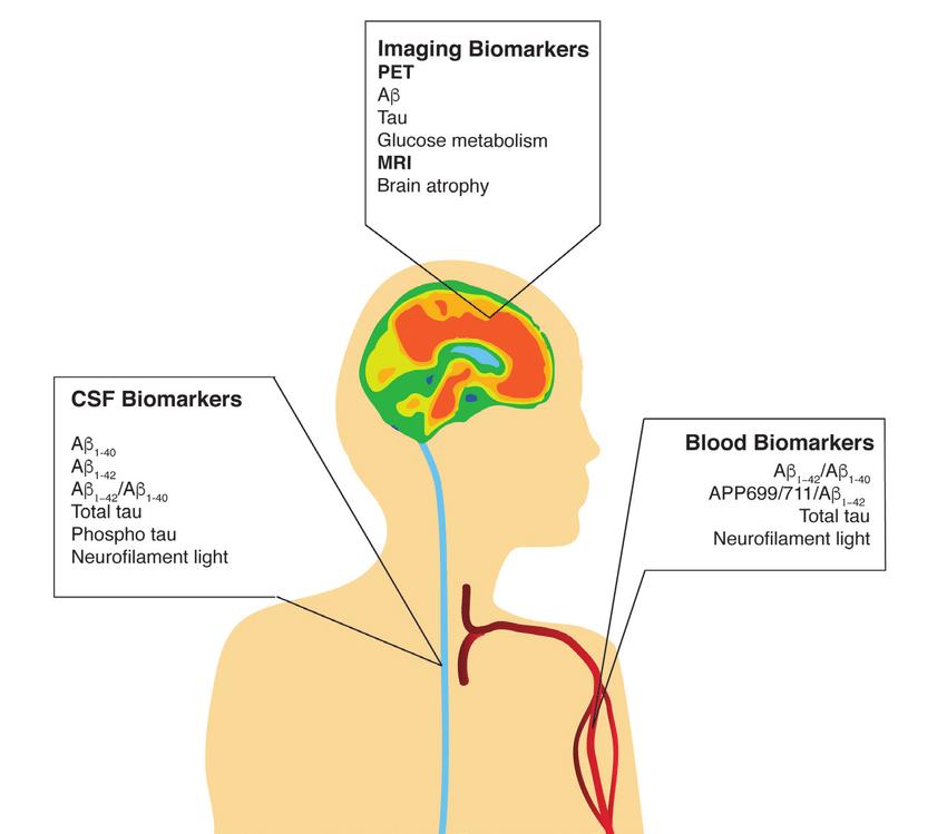Biomarkers Alzheimer: