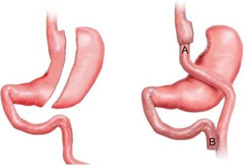 Hoe het hoort: maag duodenum CCK zorgt voor afgifte gal N Vagus regelt Alvleesklier/gal afgifte Intrinsic Factor