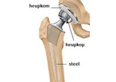 De operatie Hoe zit de kunstheup in elkaar? De kunstheup wordt ook wel heupprothese genoemd.