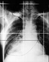 2 lopende studies ivm dosis: Timing CONVERT: Phase III trial of TRT in patients with limited-stage small cell lung cancer receiving cisplatin and etoposide.