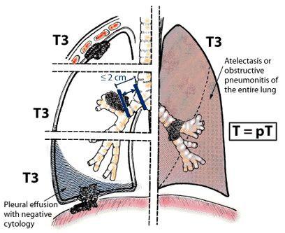 greatest dimension, surrounded by lung or visceral pleura, without bronchoscopic evidence of