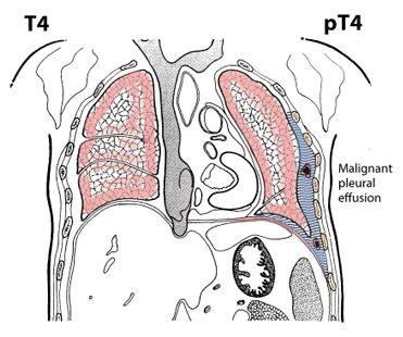 visceral pleura associated with atelectasis or obstructive pneumonitis that extends to the hilar