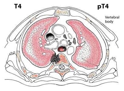 involvement of the carina; or associated atelectasis or obstructive pneumonitis of the entire lung